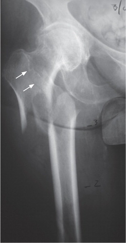 Radiograph from the paper by Feldstein et al. (Citation2012) of a fracture classified as “atypical”. There is a fracture line extending into the greater trochanter (arrows inserted by Acta) which is a typical feature of a fragility type fracture and excludes classification as an atypical fracture. (Published with permission from JBMR).