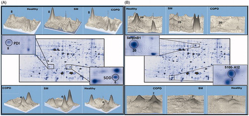 Figure 2. Representative 3-D images of differentially-expressed proteins in PMN. Differentially-expressed proteins spots in lysate from PMN of the same control, SM-exposed, and COPD subject shown in Figure 1. (A) PDI (Spot 8) and SOD (Spot 6). (B) SerpinB1 (Spot 20) and S100A12 (Spot 2). Data were analyzed using Image master 2-D platinum software.