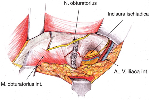 Figure 3. Plating option for fractures of the dorsal column.