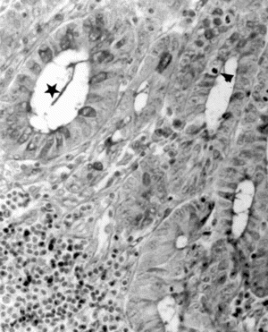 Figure 6 Micrograph of rat colon mucosa of TNBS group. Dilated crypts (★); mitosis (arrowhead). PAS-hematoxylin, × 250.