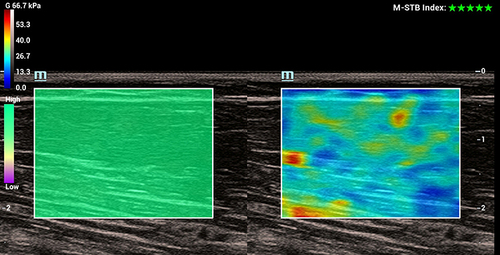 Figure 1 Shear wave quality is estimated using a shear wave quality map. Homogeneous green of the left image in the region of interest indicates good quality of shear wave speed estimation; the credibility index is 100%.