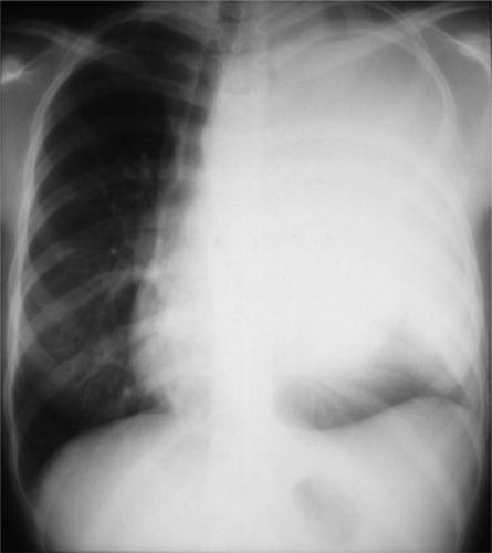 Figure 2. Large Ewing sarcoma of the rib showing pleural effusion on the left side. Destruction of costa 4 sin.