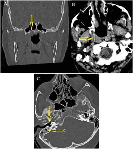 Figure 2. Paranasal sinuses CT scan. (A and B) In the coronal and axial Paranasal sinuses CT scan images of the bone and soft tissue window at the level of the nasopharynx, evidence of asymmetry of the right superolateral wall compared to the left (indicated by arrows) was observed. (C) In the axial CT scan images obtained at the level of the mastoid and middle ear cavity, evidence of effusion was observed in the right mastoid air cells (indicated by arrow number 1) without any evidence of effusion in the middle ear (indicated by arrow number 2).