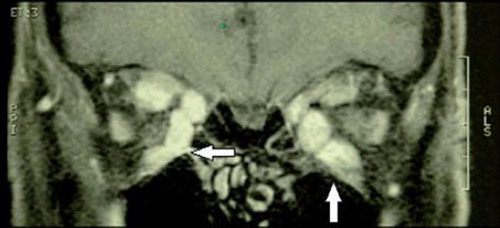 Figure 6. Bilaterally enlargement of extraocular muscles, especially in the inferior and medial rectus muscles, in a patient with thyroid eye disease.
