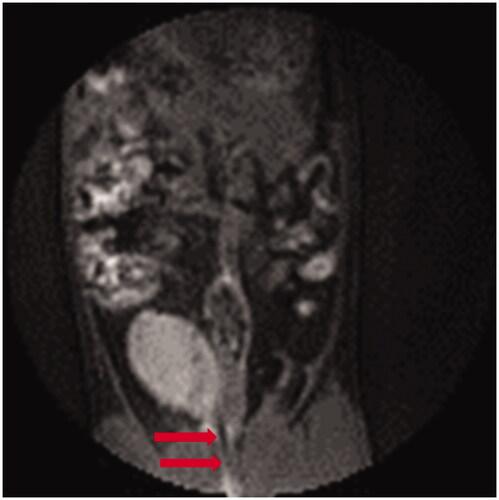 Figure 3. Pretreatment MRI image showing the rat bladder filled with 0.5 mL of 0.5 mg/mL magnetic fluid. Arrows highlight the catheter placement through the urethra to the bladder.