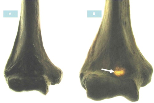 Figure 2.  Photograph showing A: translucency of septum was absent; and B: translucency of septum was noticed.