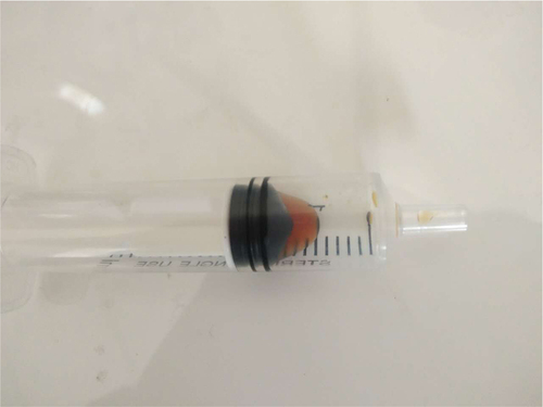 Figure 2 About 0.8 mL of a brown secretion was aspirated from the cyst of the nasal tip using a syringe.