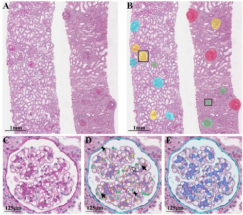 Figure 2. Identification of glomerular lesion types and intraglomerular structures in periodic acid–Schiff (PAS) slides from allograft IgAN patients by the analytic renal pathology system (ARPS). (A) A section of a whole slide image (WSI) from allograft IgAN patients. (B) Segmentation and location of glomerular lesion types in the WSI by the ARPS. Each glomerulus is categorized into global glomerular sclerosis (green), segmental glomerular sclerosis (yellow), crescents (red), and none of the above (blue). [Display full size], the glomerular lesion was identified incorrectly. (C) A glomerulus (none of the above) in a WSI. (D) Intrinsic glomerular cell segmentation and identification, including mesangial cells (blue), endothelial cells (yellow), podocytes (green), and glomerulus boundary. [Display full size], the intrinsic glomerular cell was not identified and located; [Display full size], the intrinsic glomerular cell was identified incorrectly; [Display full size], other internal glomerular structure was misidentified as intrinsic glomerular cell. (E) Location of mesangial region and mesangial cells.