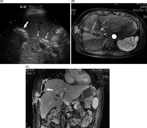 Figure 1. (a-c) US and MRI scans show abscess formation following microwave ablation (MWA) of intrahepatic cholangiocarcinoma with Cholangiojejunostomy. A 3.2-cm metastasis in a 52-year-old man was treated with MWA. (a) ultrasound scan shows the gas inside bile duct (thin arrows) arrived at ablation zone from liver hilar and hyperechoic ring of gas distribute around ablation zone 3 days after ablation (thick arrow). (b) MRI scan shows the pus developed from ablation zone to right thoracic cavity along needle track and forming a dumbbell-shaped abscess cavity (arrow). (c) Coronal MRI scan shows abscess in right thoracic cavity (thick arrow) coming from ablation zone involved soft tissue of chest wall (thin arrows) along coagulated needle track.