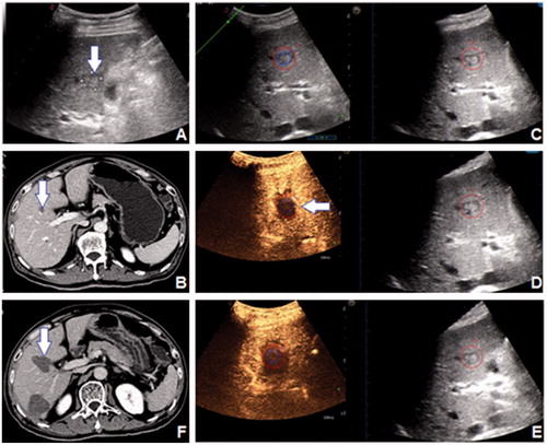 Figure 3. A 61-year-old male patient had a 16 mm HCC tumour in segment 5, which was shown (arrow) on (A) 2D US and (B) CECT. (C) The 3D US-US fusion imaging of the lesion before RFA. The real-time US image is shown at left, and the pre-ablation 3D US image is shown at right. (D) Initial assessment of the ablation effect on 3D US-CEUS fusion imaging after RFA. The non-perfusion area covered the entire lesion, but part of the AM was not covered (arrow). The assessment result was Grade B. (E) Ultimate assessment of the ablation effect on 3D US-CEUS fusion imaging after supplementary ablation. The non-perfusion area covered the entire lesion and the 5 mm AM. The assessment result was Grade A. (F) CECT one month after RFA demonstrated the technique effectiveness of the ablation (arrow).