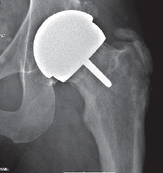 Figure 1. Osteonecrotic hip without necrotic signs on plain radiographs, 1 year after surgery.