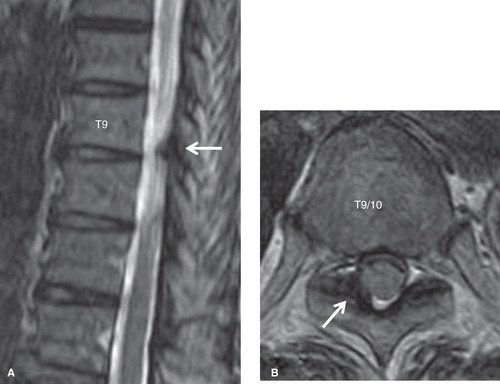 Figure 2. T2-weighted MR images of the thoracic spine. The ligamentum flavum at the right T9–10 level was thickened (arrows). A: sagittal view. B: axial view.