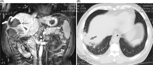 Figure 2. (a, b) MRI and CT scan showed abscess forming after ablation involved right thoracic cavity and inferior lobe of right lung. Four metastasis in a 56-year-old man were treated with MWA. (a) Coronal MRI scan shows two abscess forming 12 days after MWA (thin arrows) and superior abscess involved right thoracic cavity via needle track (thick arrow). (b) transverse CT scan shows pus in right thoracic cavity involved inferior lobe of right lung and induced consolidation of local lung (arrow) and limited inflammatory respond: the patient had symptom of cough and purulent sputum.