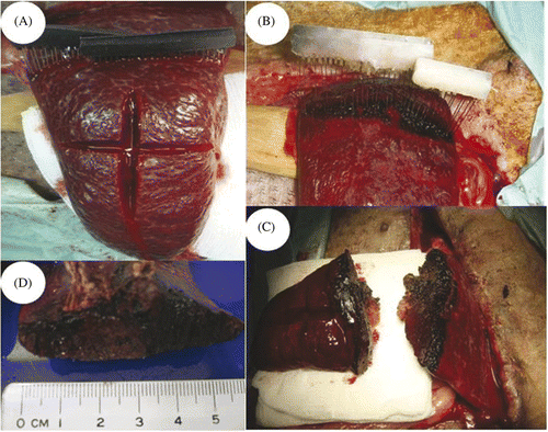 Figure 3. Procedures of the partial splenectomy using the electromagnetic thermal surgery system. (A) The needle arrays were inserted 15 cm from the tip of the spleen. (B) After heating, the Thermolite attached to the needle arrays changed colour from black to white when the temperature was above 70°C. (C-D) The cut surfaces of the spleen showed effective coagulation without signs of oozing.
