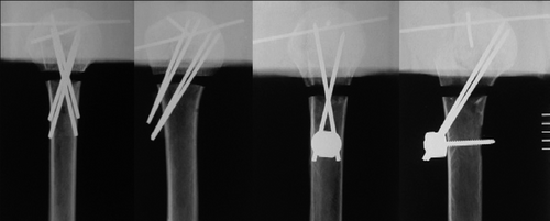 Figure 2. Postoperative radiographs showing successful implantation of the ButtonFix (left) and Humerusblock (right).
