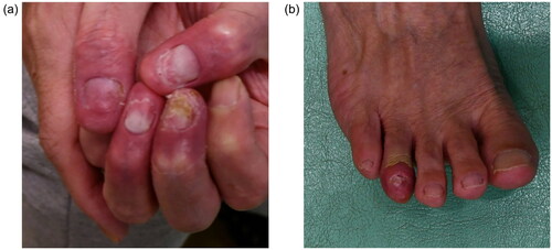 Figure 1. (a,b) Clinical findings on initial presentation. (a) and (b) illustrate painful erythema and swelling of the distal digits, nail hyperkeratosis, and detachment.