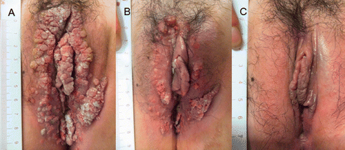 Figure 1. Extensive genital warts in patients with type I DM. Warty lesions before treatment (A), four weeks after hyperthermia (B), complete clearance of lesions nine weeks after hyperthermia (C).