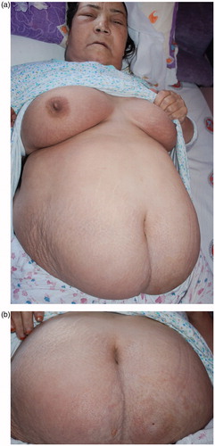 Figure 1. (a) Diffuse anasarca-type edema on the abdomen, chest, and face. (b) Mild erythematous, indurated, hard, diffuse plaques.