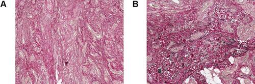 Figure 5 EVG staining (×100) showed that there were fewer elastic fibers in the desmoplastic melanoma lesion (A) than in the para-cancer lesion (B).