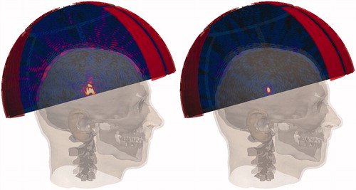 Figure 4. Simulated acoustic pressure distributions from an idealised model of the ExAblate® 4000 system applicator in the presence of a human head model segmented from MR data [Citation77,Citation78] on planes through the location of the geometric focus. (Left) Pressure distribution in the presence of skull-induced aberrations, including shifting and distortion of the focal spot, significant energy deposition on the skull bone and scalp, as well as the potential generation of secondary foci and standing waves. (Right) Pressure distribution after application of a ‘virtual source’ phase-correction approach.