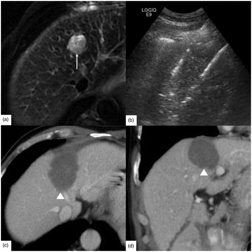 Figure 4. A 65-year-old male had hepatocellular carcinoma with liver cirrhosis. CEA was 1.61 ng/ml, α-AFP was 2.14 ng/ml and CA-199 was 10.20 U/ml. (a) Enhanced magnetic resonance imaging (MRI) before radiofrequency ablation (RFA) showed the tumor size was 2.6 × 2.3 cm (↑). (b) RFA was performed under ultrasound guidance with three 4 cm tip RF electrodes and the distance of electrodes was 1.6 cm. One month follow up contrast enhanced computed tomography on axial section (c) and coronary section (d) showed the ablation zone (△) had no enhancement. The length, width and thickness of ablation zone was 5.5 cm, 4.0 cm, 3.7 cm, respectively.