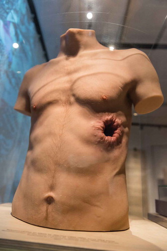 Figure 3. Silicone torso made to resemble Alexis St. Martin, a young man who in 1822 survived a gunshot wound to the stomach but developed a permanent fistula. He was treated by the physician William Beaumont, who later experimented on him by tying food on silk strings and inserting them into the stomach through the fistula. Beaumont’s pivotal observations was published in 1838, in the book Experiments and Observations on the Gastric Juice, and the Physiology of Digestion. Copyright Medical Museion.