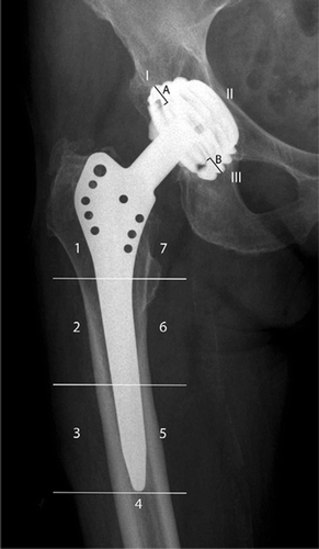 Figure 3. Frontal radiograph with Gruen femoral zones 1–7 and De Lee-Charnley acetabular zones I—III. Polyethylene wear was estimated along a line from the superior to the inferior edge margins of the cup. The distances from the superior (A) and the inferior (B) edge margins to the femoral head were measured with a manual calliper. Linear wear was calculated using the formula (A-B) /2.The measurements were corrected for magnification using the 32-mm diameter of the femoral head.