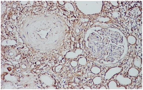 Figure 1. Intense positive vimentin immunostaining at the level of the interstitium, peritubular, and periglomerular. Vimentin stain LSAB2-DAB × 100.