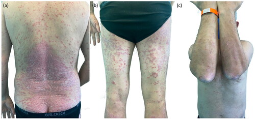 Figure 1. (a–c) Clinical presentation of exacerbation of psoriasis.