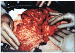 Figure 1. Exploratory laparotomy revealing multiple adhesions between bowel loops. The miliary nodules were throughout the abdominal cavity including bowel wall, omentum, and mesentery.