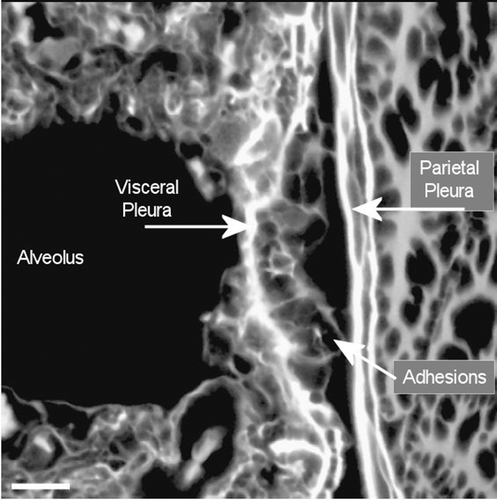 Figure 18.  View of the pleural space from an animal exposed to amosite asbestos at 272 days postexposure. The subpleural alveolar septa seen in the left center of the image contains fibrotic lesions (thicker bright white matrix is indicative of enhanced collagen deposition). The parietal pleura and chest wall is shown on the right. Within the alveolus on the left, a number of subpleural macrophages can be seen.