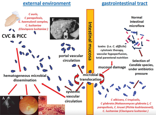 Figure 1. Pathogenesis and hematogenous routes of Candida species bloodstream dissemination with possible secondary infections as endocarditis (A), retinitis (B), skin fungal vasculitis (C) with macular/papular lesion (D) and multifocal hepatitis (E). CVC: central venous catheter; PICC: peripherally inserted central catheter.