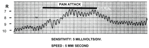 Figure 1 Dynamic tonometry recording prior to, during, and following a pain paroxysm. Copyright © 1992. Reproduced with permission from CitationSjaastad O, Kruszewski P, Fostad K, et al 1992. SUNCT syndrome: VII. Ocular and related variables. Headache, 32:489–95.