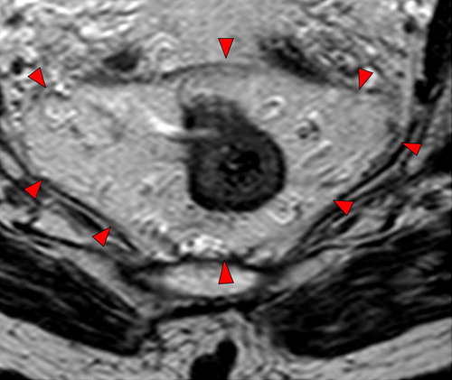 Figure 3.  High resolution T2-weighted axial MRI through rectal tumour showing the fascia propria of the mesorectum (red arrowheads) which corresponds to the surgical circumferential resection margin.