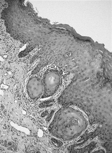 Figure 1.  Invasive moderate differentiated squamous cell carcinoma of the conjunctiva. Hematoxylin and eosin.