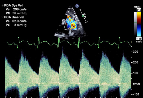Figure 4 Doppler gradient through the PDA — Although the peak velocity is almost 3 m/s (300 cm/s), there is significant pulsatility indicated by systolic to diastolic velocity ratio >2. This suggests a significant shunt.