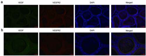 Figure 1. Expression of VEGF and VEGFR2 was detected by immunofluorescence. (a): Magnification, × 200, (b): Magnification, × 400. Immunofluorescence staining showed that cells positive for VEGF and VEGFR2 were predominantly observed in the cytoplasm of all principle cells, some of the interstitial small vascular endothelial cells, and in some blood capillaries and sperm in the ductus epididymitis. VEGF, Vascular endothelial growth factor; VEGFR2, VEGF receptor 2