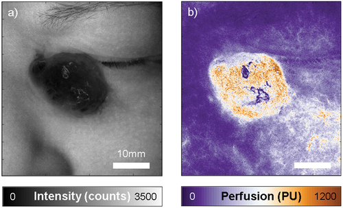 Figure 2. Laser speckle contrast imaging of the angiosarcoma, showing an intensity map on the left (a), and the corresponding perfusion map on the right (b). Perfusion in the tumor is markedly higher than in the surrounding skin. Perfusion and intensity are expressed in arbitrary units, intensity counts and perfusion units (PU). Both images are scaled the same and the scale bar represents 10mm.