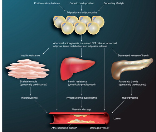 Figure 1. Relationship between adiposopathy (pathogenic adipose tissue) and metabolic disease.Increased circulating FFAs may be lipotoxic to muscle, liver and pancreas. When adipocytes become excessively enlarged, especially in the setting of visceral adiposity, adipocyte and adipose tissue dysfunction (i.e., ‘adiposopathy’) may result in adverse metabolic consequences. One of the manifestations of adiposopathy is a relative increase of intra-adipocyte lipolysis over that of intra-adipocyte lipogenesis, leading to a net release of FFAs, insulin resistance and diminished pancreatic insulin secretion, all leading to hyperglycemia and possible diabetes mellitus, as well as other metabolic diseases. Steatosis, or ‘fatty liver’, is another consequence of increased FFA delivery to the liver.FFA: Free faty acid.Adapted with permission from Future Medicine Ltd Citation[7].