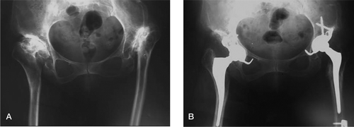 Figure 6. A. Low CDH of the right hip and high CDH of the left hip. B. The same patient: right THA at 55 months and left THA at 65 months after surgery.