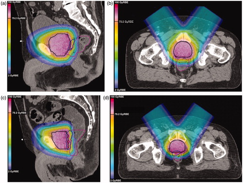 Figure 2. Demonstrations of variable RBE weighted (vRBEw) dose distributions for anterior-oblique spot-scanned proton therapy plans with a uniform 5 mm CTV to PTV margin. The planning target volume is contoured in black; the hydrogel, contoured using additional magnetic resonance data, is shown in blue; and the rectum is contoured in pink. The dose distributions overlaid here are for vRBEw dose calculated according to the McNamara model with an α/β of 3 Gy. (a) Sagittal view of case where spacer was least effective; (b) axial view of case where spacer was least effective; (c) sagittal view of more typical case; (d) axial view of more typical case.