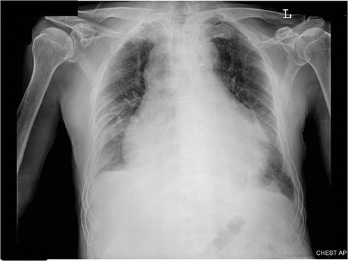 Figure 1.  Chest PA showing large and globular heart.