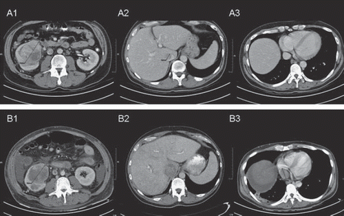 Figure 1. CT scans of the first patient at baseline (A) and after (B) one cycle of sunitinib. A1 and B1: The primary tumour has decreased in size. A 2–3 and B 2–3: The caval vein thrombosis has increased in size (A2 and B2) and extends from infrahepatic (A2) towards the right atrium (B3). Note the absence of the thrombus in the right atrium before treatment (A3).
