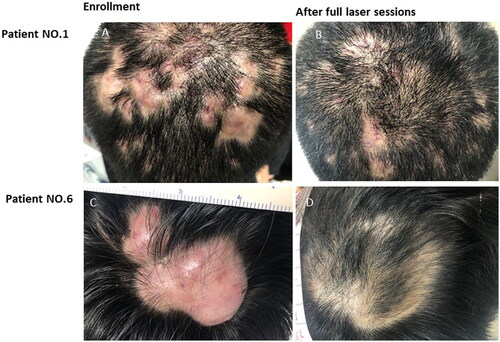 Figure 2. Marked improvement of scalp lesion and hair regrowth before and after Erbium: YAG laser treatment sessions. Patient No.1 before (A) and after (B) 3 sessions. Patient No.6 before (C) and after (D) 3 sessions.