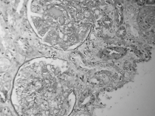 Figure 3. Renal tissue section showing marked global endocapillary and mesangial proliferation with scattered polymorphonuclear infiltrates. Several capillaries contain eosinophilic intraluminal deposits that form hyaline thrombi (H+E stain).