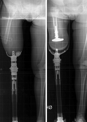Figure 2. Femoral alignment before and after insertion of the FCE.