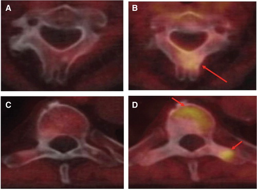 Figure 3. [18F]FACBC positron emission tomography/computed tomography fused images of C2 (upper row) and Th7 (lower row) for patient no. 13: pretreatment (left column) and post-treatment (right column). Tumour expansion with increased FACBC uptake (arrows) in areas of no/very weak uptake pretreatment, interpreted as new tumour tissue.