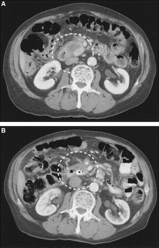 Figure 2.  (A) An abdominal CT scan performed before chemotherapy showing a tumour in the head of pancreas involving the superior mesenteric vein. (B) An abdominal CT after 3 months of chemotherapy demonstrating a decreased tumour. The superior mesenteric vein is no longer occluded.