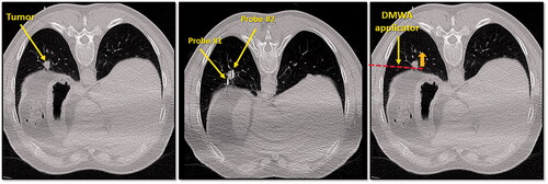 Figure 5. CT image of 1.6 cm lower lobe lung tumor abutting the diaphragm (left image). The challenge in this case is successfully ‘skewering’ the tumor with the ablation applicator without lesion ‘roll-off’ or injury to the diaphragm. CT image of ‘chopstick’ technique to enable treatment of this with existing cryoablation probes (middle image). Two cryoprobes are used; cryoprobe #1 is advanced alongside the tumor and a ‘stick freeze’ is performed to adhere the nodule and enable puncture with cryoprobe #2. Cryoprobe #1 is then thawed and repositioned in the nodule in parallel with probe #2. Illustration of hypothetical DMWA applicator ‘outside-in’ placement (red dashed line) and direction of aim (orange arrow) to treat the tumor and avoid the diaphragm (left image).