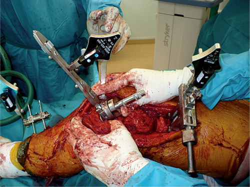 Figure 6. Imageless resection and reconstruction. The CAS tibial guide is used to check the cut angulation and placement of the tibial component. Reconstruction was done with a GMRS/MRH prosthesis, with the CAS system being used for rotation control, joint angulation control, and length reconstruction.